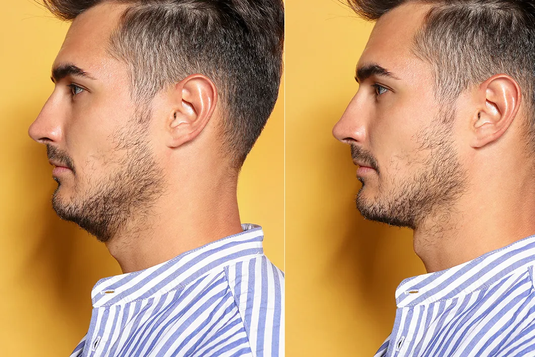 La génioplastie, chirurgie du mention à la clinique lorraine du visage - Nancy