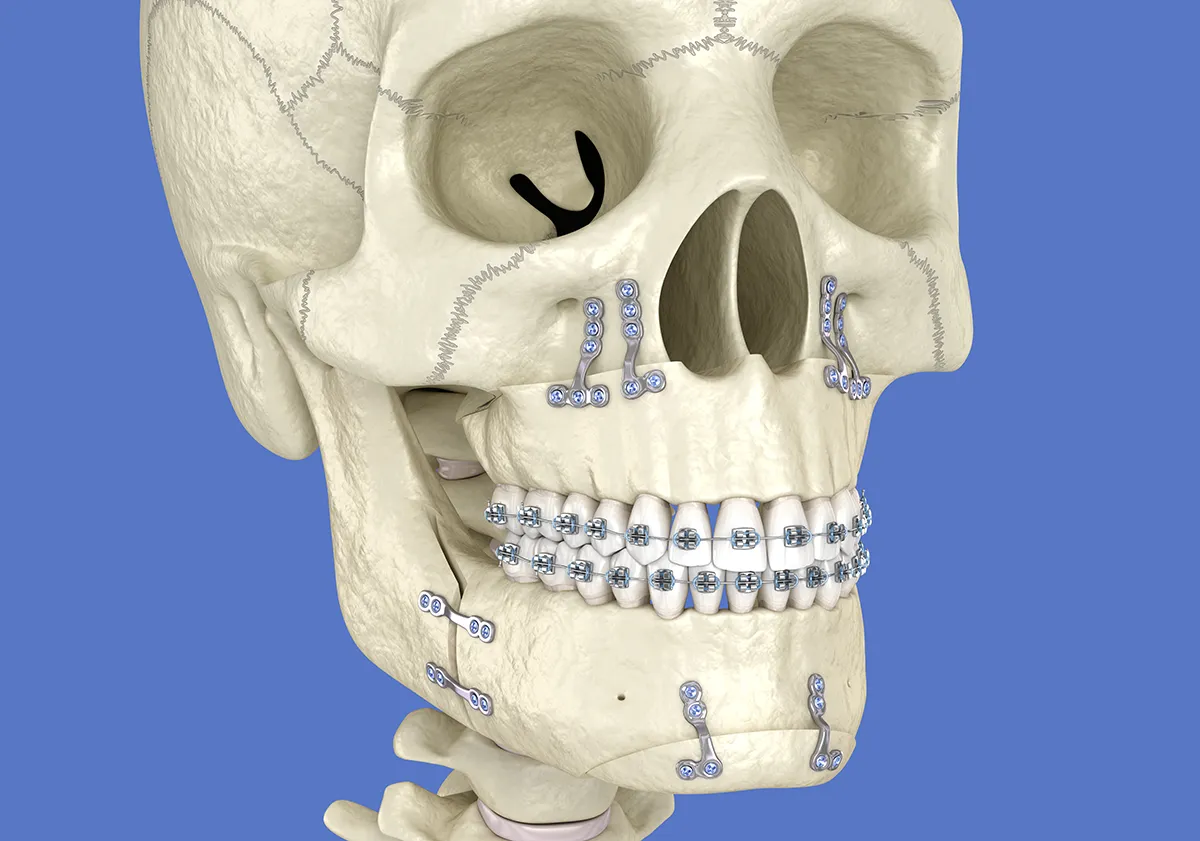 Chirurgie bi-maxillaire à la clinique lorraine du visage à Nancy