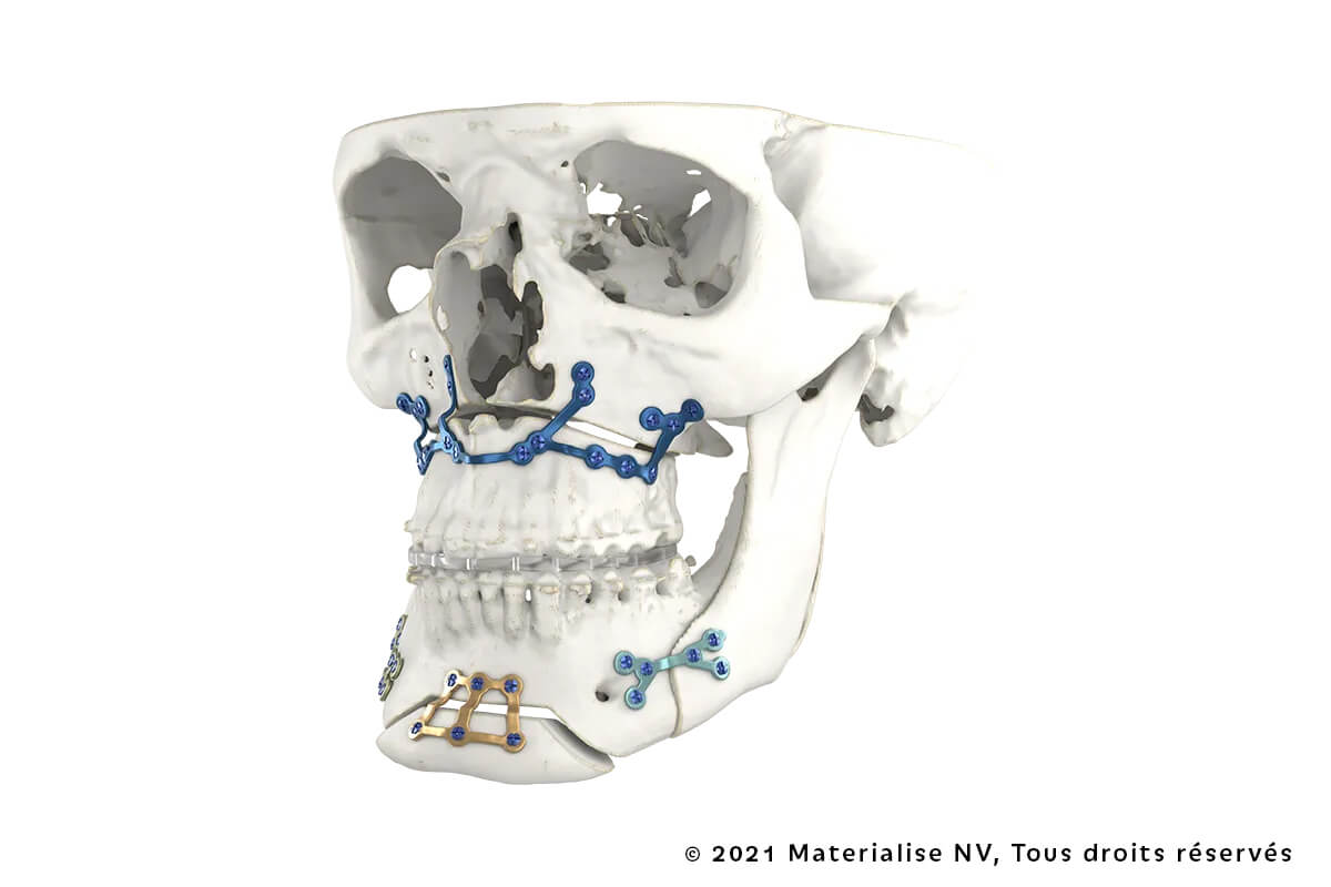 Planification Virtuelle & Dispositifs Sur Mesure en Chirurgie Orthognathique