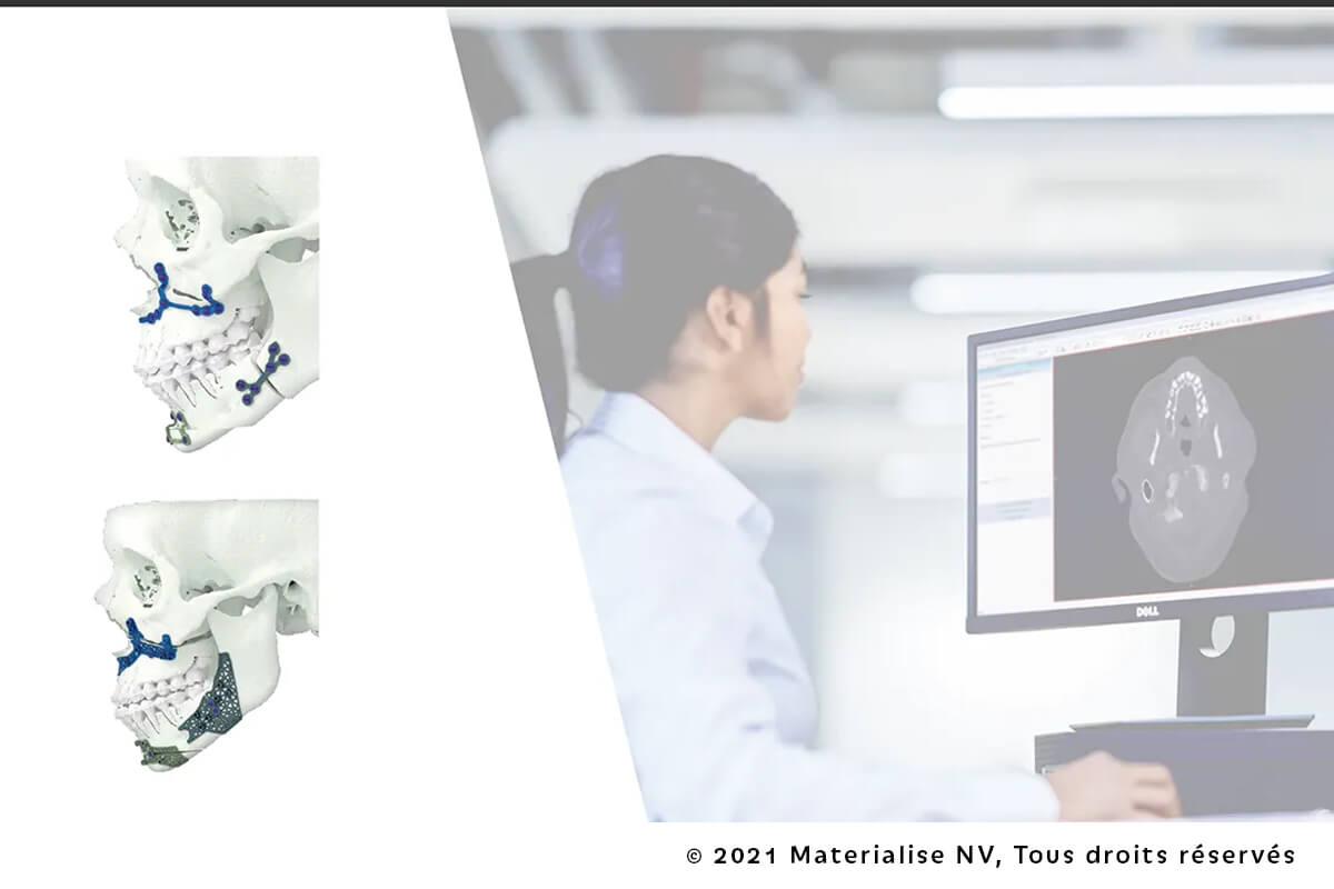Planification Virtuelle & Dispositifs Sur Mesure en Chirurgie Orthognathique