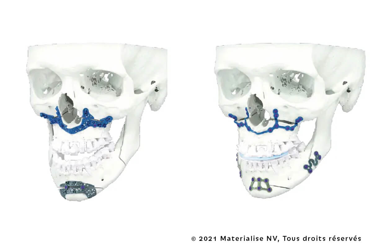 Planification Virtuelle & Dispositifs Sur Mesure en Chirurgie Orthognathique