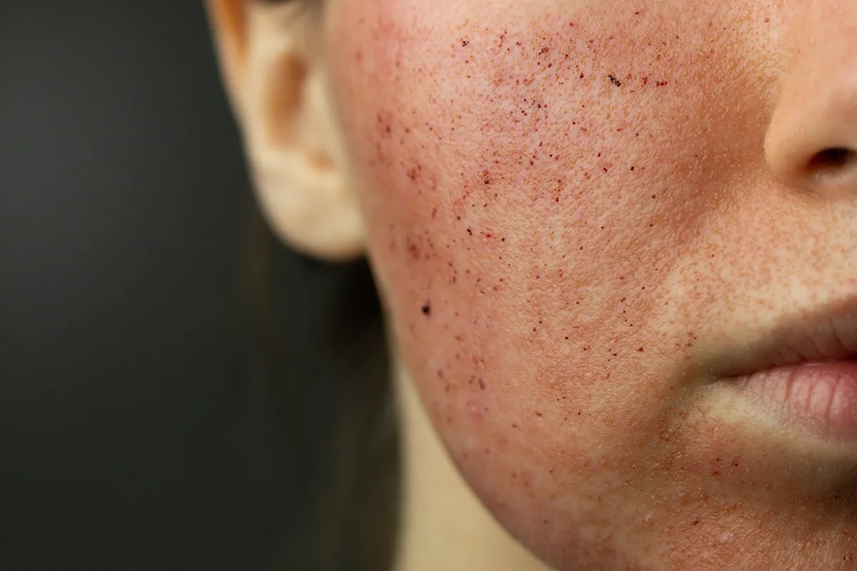 Laser CO&sup2; &agrave; la clinique lorraine du visage &agrave; Nancy