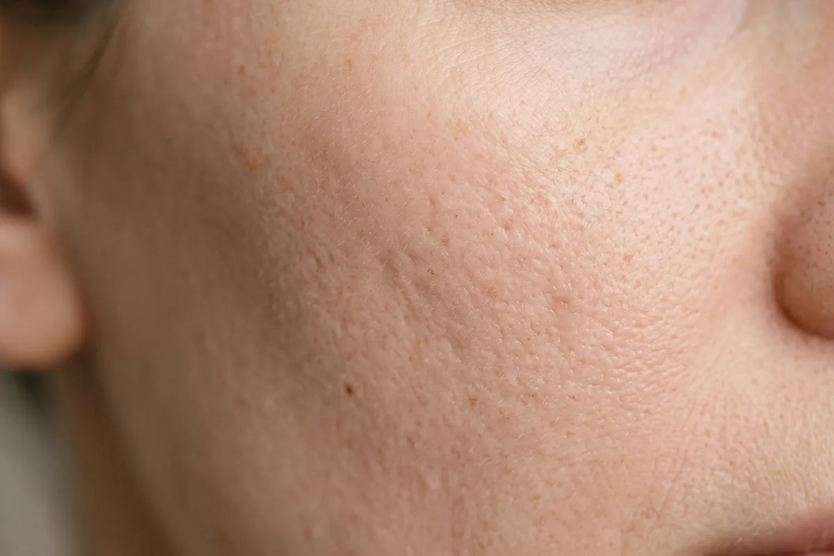 Gros plan sur la joue d'une femme montrant des pores dilatés, de petites irrégularités et des marques en creux.