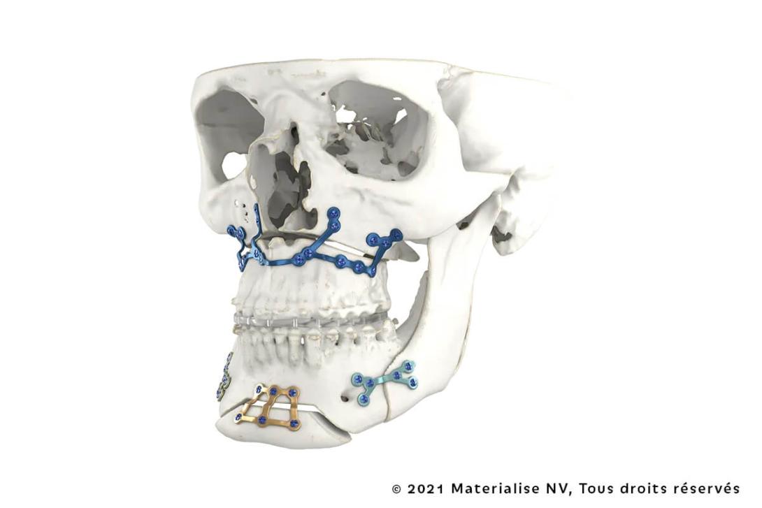 Planification Virtuelle & Dispositifs Sur Mesure en Chirurgie Orthognathique