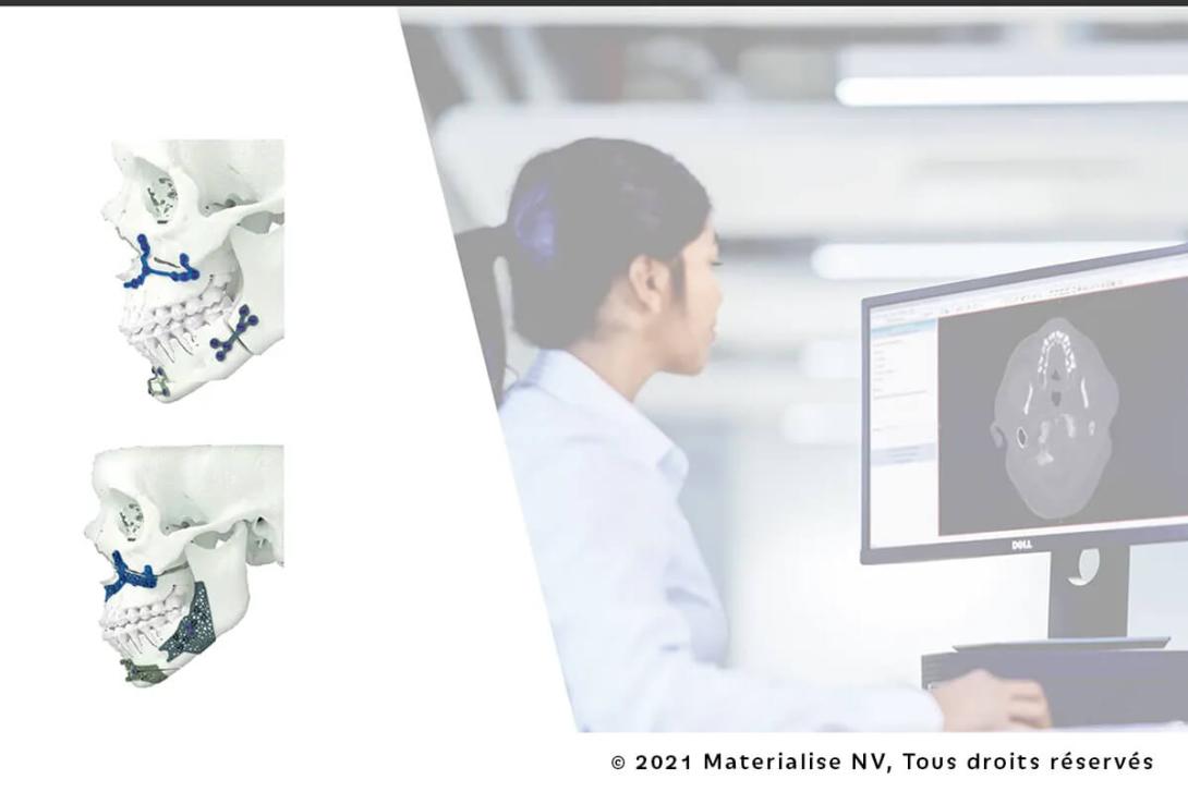 Planification Virtuelle & Dispositifs Sur Mesure en Chirurgie Orthognathique
